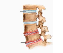 Osteokondrosia