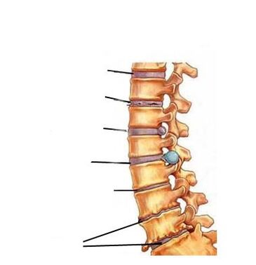 osteokondrosiaren garapenaren faseak