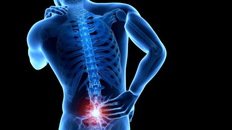 bizkarreko mina lumbar osteokondrosiarekin